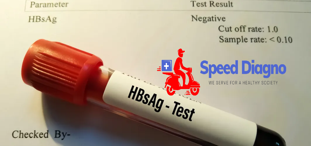 HBsAg (AUSTRALIA ANTIGEN)