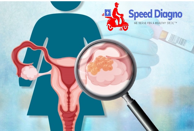 CA125 - Ovarian Cancer marker