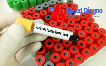 VARICELLA ZOSTER IgM (Chicken Pox)