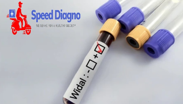 WIDAL TEST - Tube