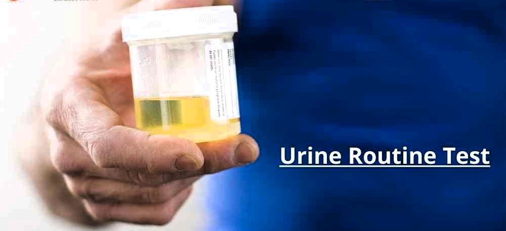Complete Urine Analysis (CUE)