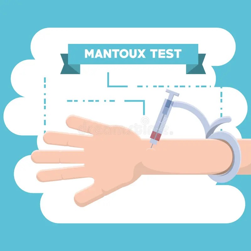 Mantoux Test Tuberculin Skin Test
