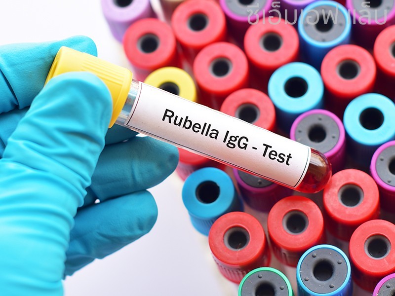 Rubella (German Measles)-IgG