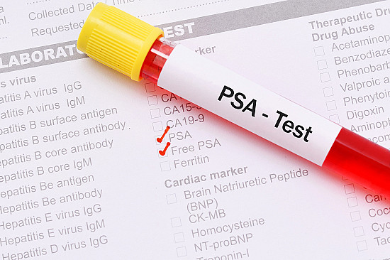PROSTATE SPECIFIC ANTIGEN ( PSA )