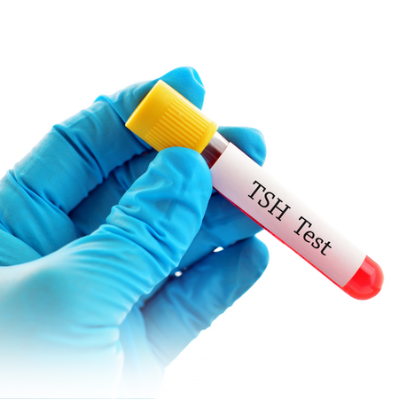 THYROID STIMULATING HORMONE (TSH)
