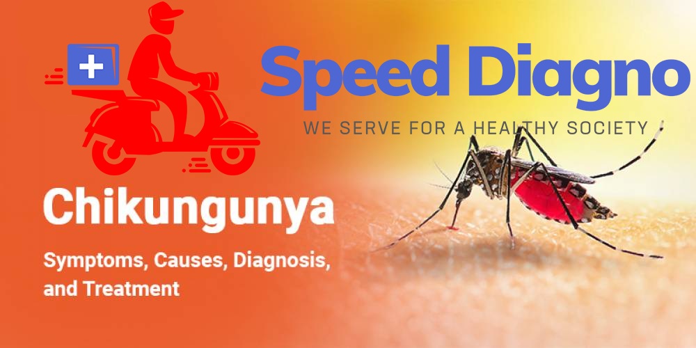 CHIKUNGUNYA ANTIBODIES IgG