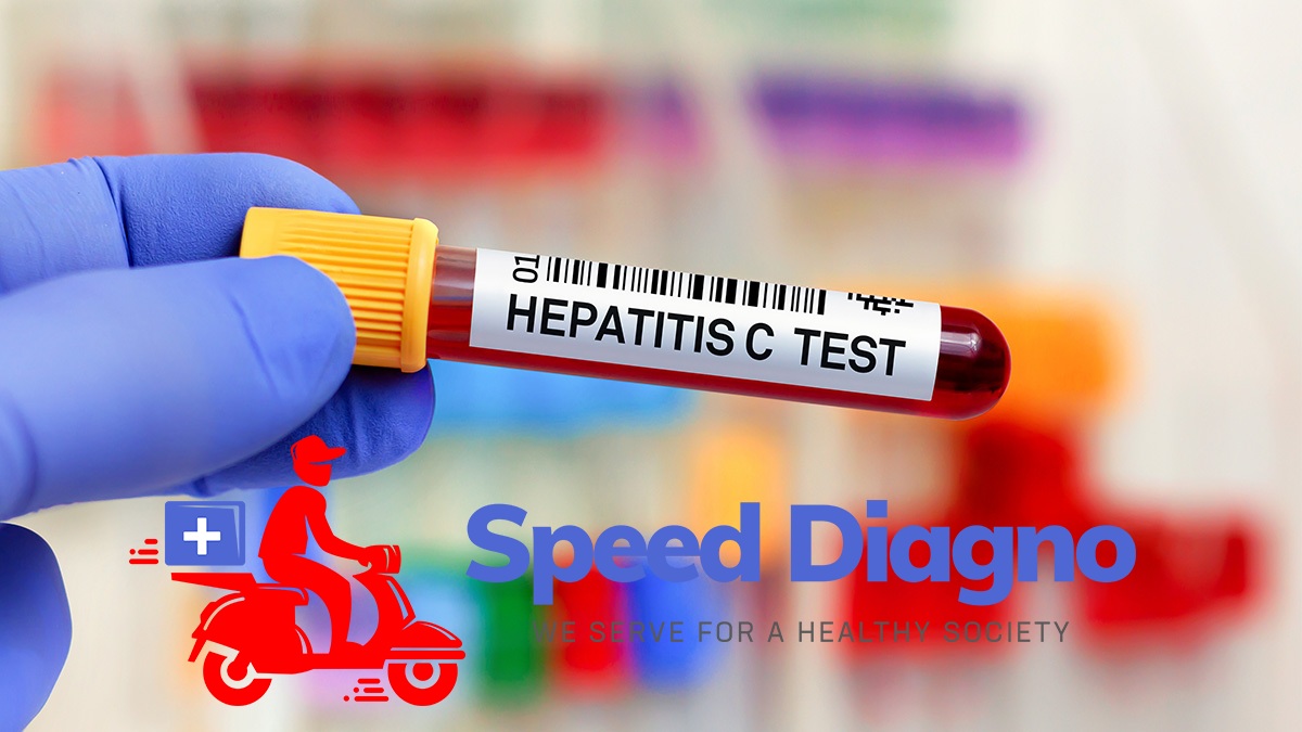 HCV - HEPATITIS C VIRUS ANTIBODIES - RAPID