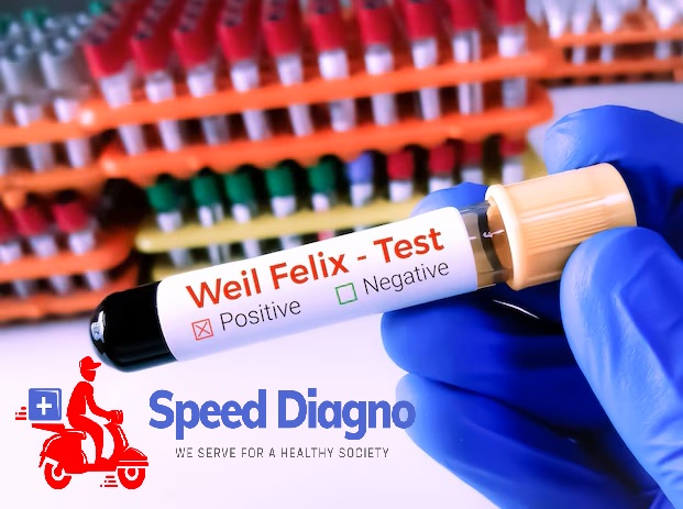 WEIL FELIX TEST