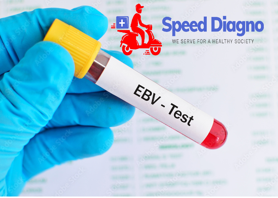 Epstein Barr Virus (VCA) - IgM ANTIBODIES