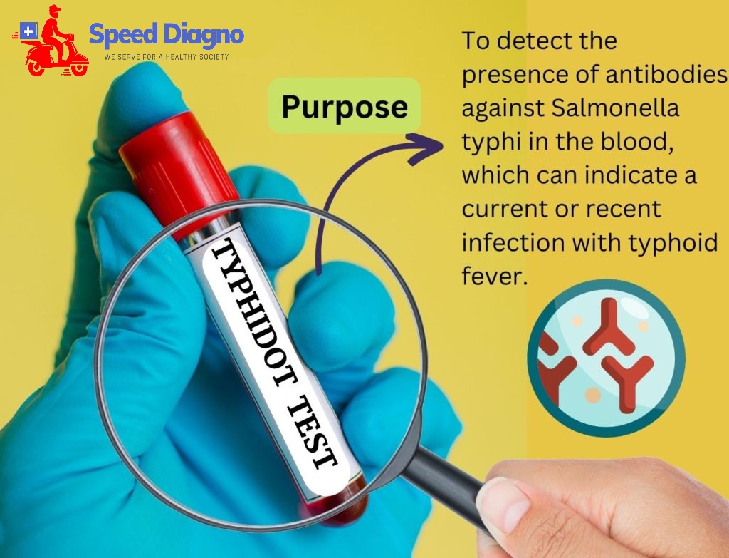 Salmonella typhi IgG & IgM (Card Test)