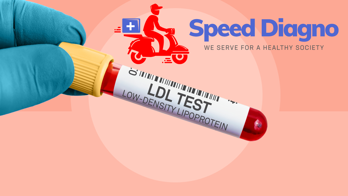 LDL CHOLESTEROL